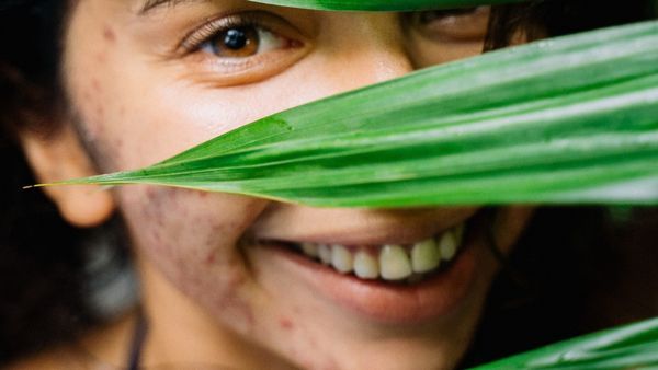 Reason 12: When you pick your face, you make your pimples worse