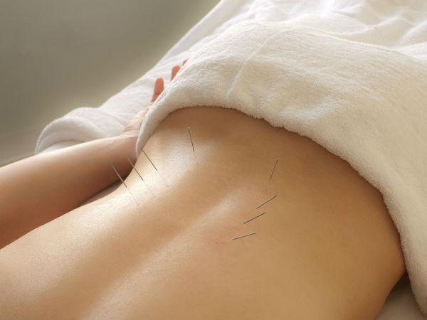 1. એક્યુપંક્ચર