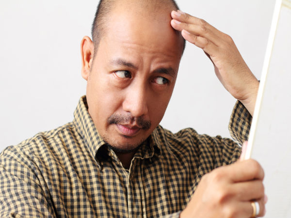 How Men Can Cover Baldness