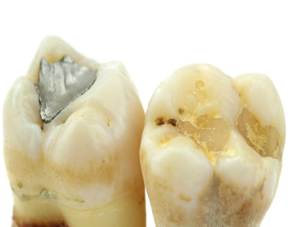 tooth extraction healing process