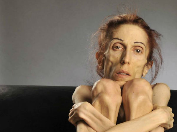 woman who suffered from anorexia