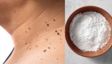 मस्से हटाने के लिए चूने का इस तरह करें इस्तेमाल