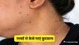 गर्दन और चेहरे के भद्दे मस्सों को दूर करने के 5 उपाय
