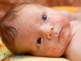 नवजात बच्चों में होने वाली त्वचा संबंधी 8 सामान्य समस्याएं 
