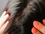 सर्दियों में रूसी दूर करने के लिये हेयर मास्‍क 
