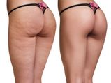   कमर और जांघो से Cellulite हटाने के 5 दमदार ट्रीटमेंट