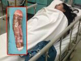 लड़की ने मजे-मजे में योनि में डाला कसावा, ले जाना पड़ा हॉस्पिटल 