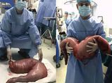 चीन में डॉक्टरों ने मरीज के पेट से निकाली 30 इंच लंबी 13 किलो की आंत 