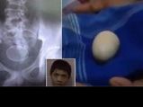 OMG! ये लड़का 2 साल से दे रहा है अंडे, डॉक्टर्स भी हुए हक्‍के बक्‍के...
