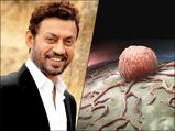 क्या होता है कोलन इंफेक्‍शन, जिससे जूझ रहे थे इरफान खान 