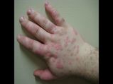 सर्दियों में होती है शीतपित्त, जानें इसके कारण और घरेलू इलाज 