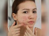 Skin Care Tips: हार्मोनल एक्ने से निजात पाने के लिए अपनाएं ये उपाय, पाएं बेदाग स्किन