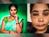 कन्नड़ अभिनेत्री का  रूट कैनाल कराने से बिगड़ा चेहरा, जानें इस ट्रीटमेंट के दौरान क‍िन बातों का रखें ध्‍यान 