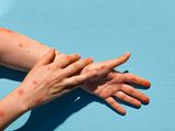  Monkeypox in India:  केरल के बाद दिल्‍ली में मिला मंकीपॉक्‍स का मामला, ये है लक्षण और बचाव 