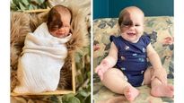 Congenital Melanocytic Nevus: चेहरे को आधा कवर कर लेता है यह बर्थमार्क, ये है इसकी वजह और इलाज