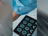 स्ट्रोक के बारे में कॉमन मिथ, इन फैक्ट्स के बारें में नहीं जानते होंगे आप 