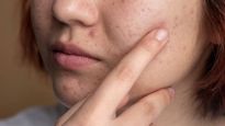 Summer Skin Care Tips: गर्मी में चेहरे पर निकलने लगे हैं बहुत सारे पिंपल, जानें क्या करें और क्या न करें