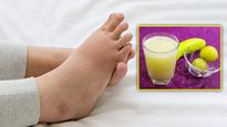 गर्मी के मौसम में  Uric Acid को रखना है कंट्रोल, डाइट में जरुर लें ये ठंडी चीजें 