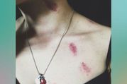 Hickey Removal Hacks:  पैशनेट किसिंग के बाद मिले लव बाइट्स से ऐसे छुटकारा पाएं