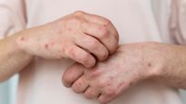 Chicken Pox Myths and Facts: जानिए चिकन पॉक्स से जुड़े मिथक और फैक्ट्स