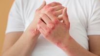 Skin Problem: ड्राई स्किन और रैशेज किडनी डिजीज का है लक्षण ! 