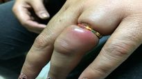 Embedded Ring Syndrome: अगर पहन रखी हैं टाइट अंगूठी, तुरंत निकाल दें वर्ना काटनी पड़ सकती हैं अंगुली