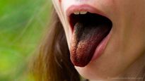 Black Hairy Tongue Syndrome : इस महिला के जीभ पर उग आए बाल, जाने इस दुलर्भ बीमारी के लक्षण और  इलाज  