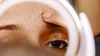 कैसे माथे में धंसे हुए ब्लैकहेड्स से पाएं छुटकारा? इन घरेलू उपायों से रातभर में साफ हो जाएंगे कील-मुहांसे 