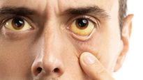  Black jaundice : जानें क्या है काला पीलिया, नॉर्मल पील‍िया से क‍ितना अलग, जानें लक्षण और बचाव 