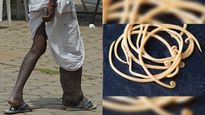 मलेर‍िया-डेंगू के अलावा मच्‍छर के काटने से हाथी जैसे फूल सकते हैं पांव, ये है हाथी पांव के लक्षण और इलाज