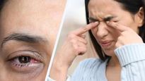 Eye Flu: आपको भी हो गया आईफ्लू! जानें आंख आने पर क्या करें और क्या नहीं? 