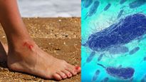 Vibrio Vulnificus: समुद्री फूड खाने वाले रहें बचके! इनमें मौजूद इंसानी मांस खाने वाले बैक्टीरिया से जा सकती है
