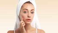   Pimple Popping With Towel : आप भी तौलिए को दबाकर फोड़ते हैं मुंहासे, जानें ऐसा करने के नुकसान 