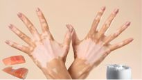  Vitiligo Myths : मछली खाने के बाद शरीर में हो जाते हैं सफेद दाग? जानें सफेद दाग से जुड़े Myths & Facts