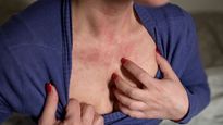 Breast Rashes: टाइट ब्रा और पसीने से स्‍तनों के नीचे बन गए चकत्ते, ठीक करने के ल‍िए करें ये काम 