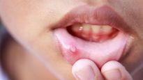 Mouth ulcers: पेट की गर्मी के कारण मुंह में हो गए हैं छाले, ये आयुर्वेदिक तरीके दिलाएंगे तुरंत आराम