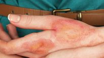 Ice Burn Remedy: आइस बर्न होने पर ये छोटे-छोटे उपाय आएंगे काम