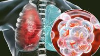 World Pneumonia Day: इन 5 लोगों के ल‍िए जानलेवा साबित हो सकता है न‍िमोन‍िया, जानें कौन बरतें सावधानी