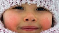  Winter Rosacea: ठंड लगने पर क्यों गुलाबी और लाल हो जाते हैं गाल? जानिए वजह और 5 विंटर स्किन केयर टिप्स 