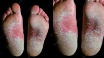Skin Peeling Feet : पपड़ीदार और बदसूरत पैरों के पीछे हो सकती है ये बीमारी, ऐसे करें घर पर केयर 