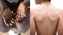 Mpox vs Chickenpox: आप भी हैं मंकीपॉक्‍स और चिकन पॉक्स के बीच कंफ्यूज, यह है दोनों में अंतर