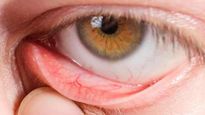  Dry Eye Syndrome: घंटों बैठकर लैपटॉप या मोबाइल पर देखते रहते हैं एकटक, सावधान वरना आपकी ये आदत बना देगी अंधा 
