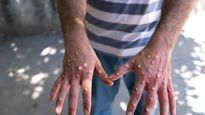 कई अफ्रीकी देशों में फैला  Mpox वायरस,  WHO ने कहा ये  लक्षण दिखने पर हो जाएं सावधान..