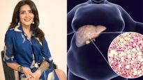 Grade 3 fatty liver : ऋतिक रोशन की बहन ने इस बीमारी की वजह से घटाए, जानें क‍ितनी ज्‍यादा है खतरनाक? 
