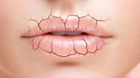  Chapped Lips : सर्दियों में होंठ फटने से न‍िकलने लगा खून, आज ही ट्राय करें ये 5 नुस्‍खें 
