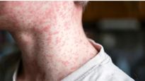 Measles के प्रकोप से हुई पहली मौत, अब तक 124 कंफर्म केस मिले, जानें लक्षण और बचाव 