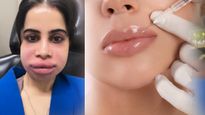 Urfi Javed ने हटवाए Lip Fillers: जानें इसके फायदे, नुकसान और कीमत