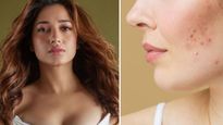 Tamannaah Skin Care : थूक लगाने से गायब हो जाते हैं मुहांसे, क्या सच में असरदार है तमन्ना भाटिया का ये तरीका?