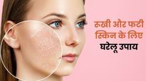 सर्दियों में फटने लगी है स्किन तो आजमाएं ये घरेलू उपाय, रूखापन होगा दूर और चेहरा हो जाएगा मुलायम