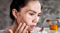 चेहरे से झाइयां हटाने के लिए शहद का इन 3 तरीकों से करें इस्तेमाल, फेस पर आएगा इंस्टेंट निखार
